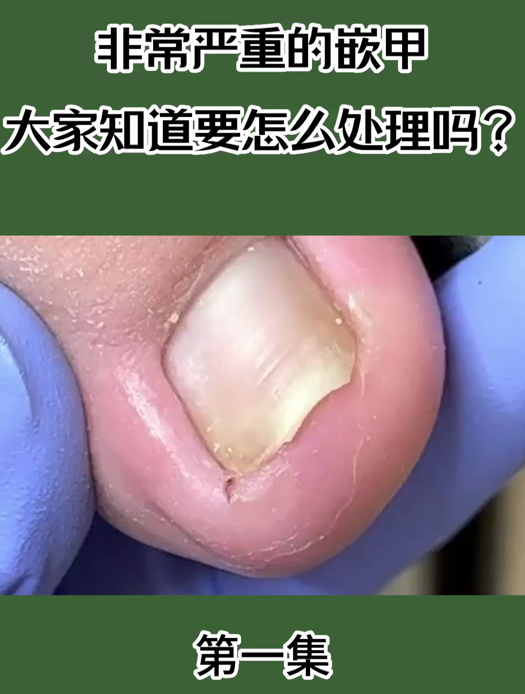 非常严重的嵌甲大家知道要怎么处理吗