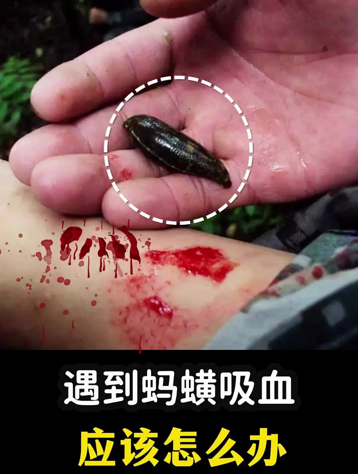 遇到蚂蟥吸血,应该怎么办?