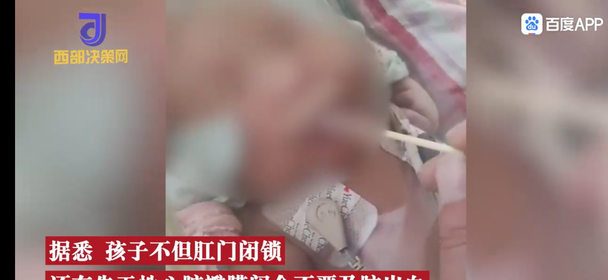 什么是肛门闭锁,早产男婴的父母为何害怕,又为何求助呢