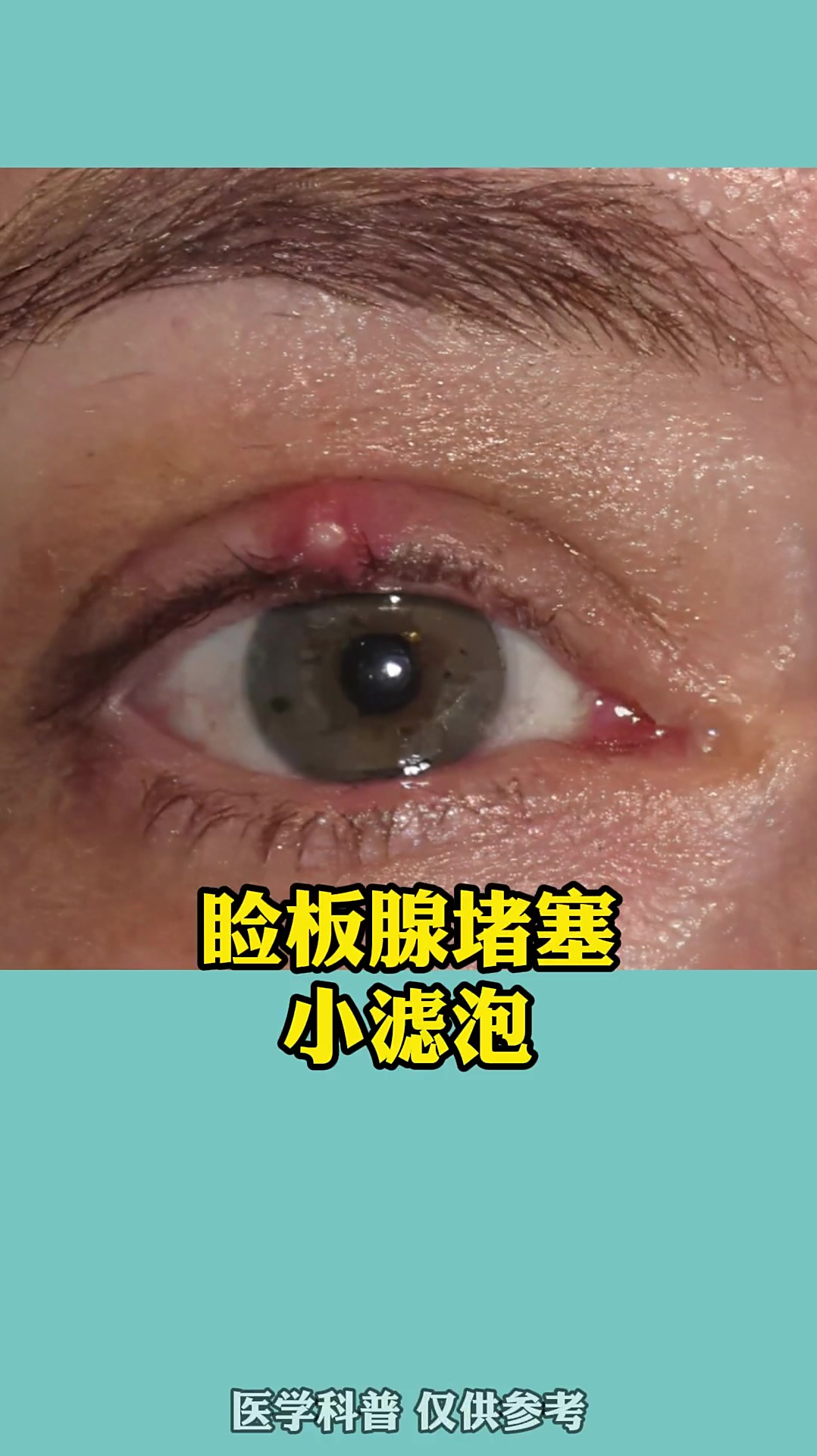 眼睛出现小滤泡,你知道是为什么吗?