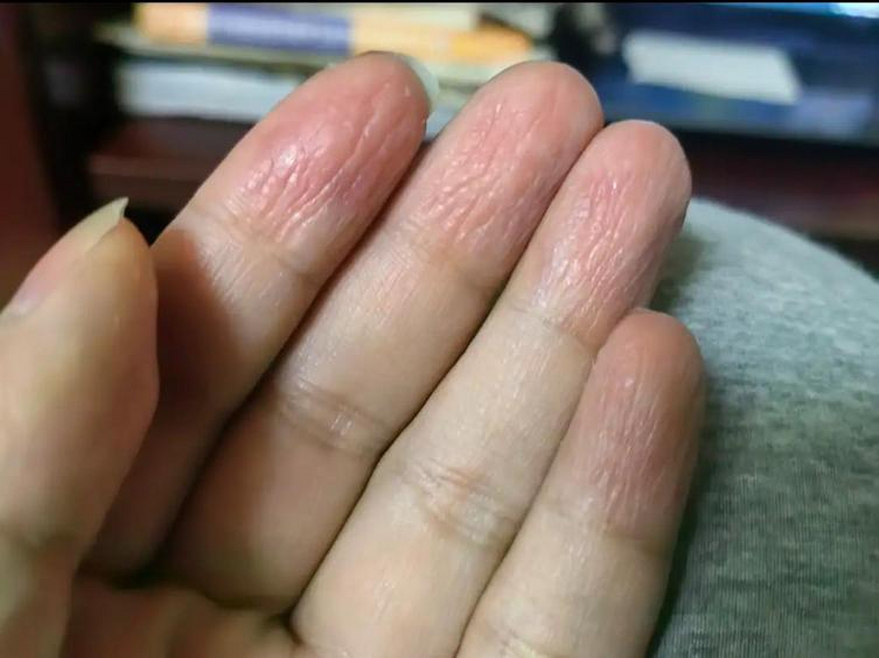 手指脱皮皱巴巴,又痛又痒,还会裂开,这到底是怎么了?