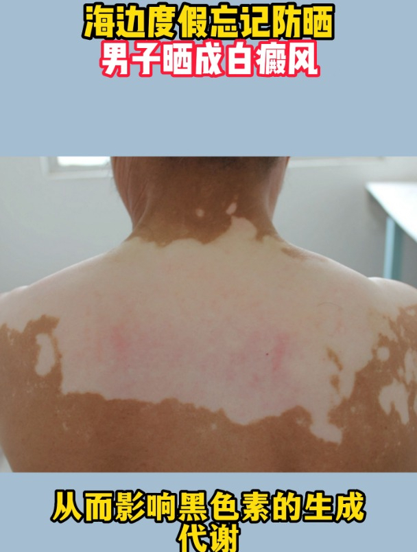 海边度假忘记防晒,男子晒成白癜风