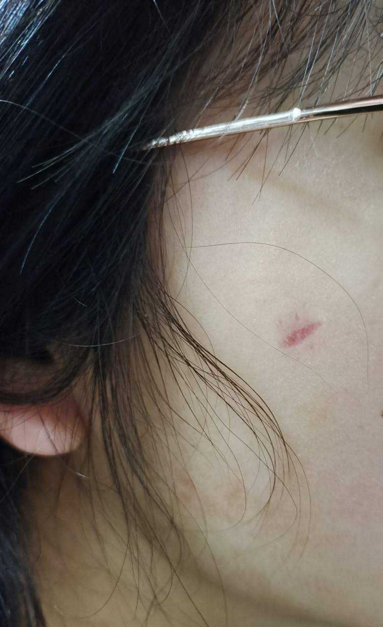 做了激光祛痣,但留下了红印怎么能快速恢复呢?