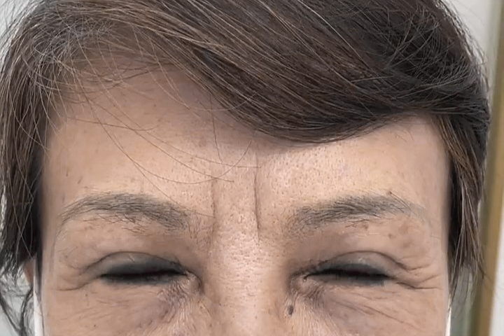 大姐川字纹很深,做了这个项目,印堂终于平整了!