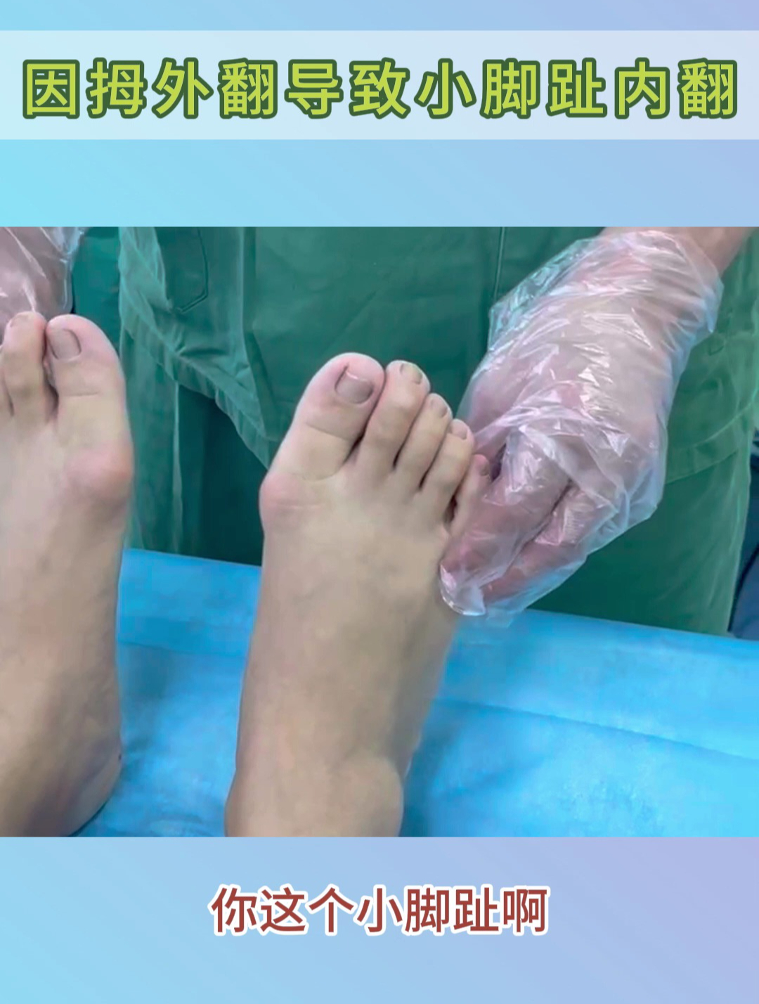 因为拇外翻畸形导致小脚趾内翻