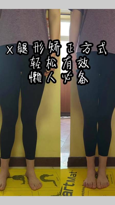 x腿形矫正方式腿形改善x型腿
