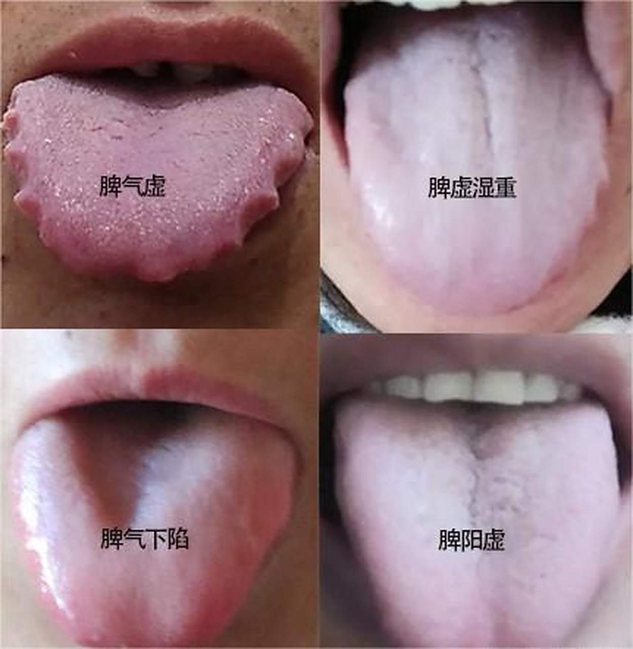 思饮食,稍吃点东西,肚子就胀得不能行,四肢易出现浮肿,舌头齿痕印明显