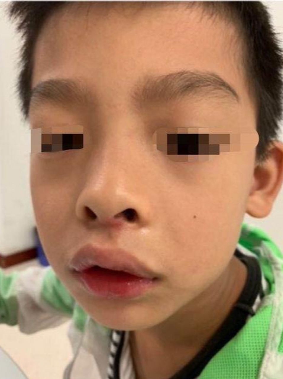 孩子迈向腺样体面容的6个信号,家长务必关注! 1.