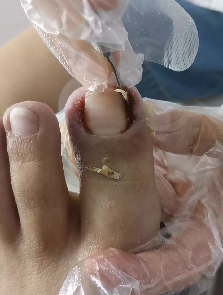 甲沟炎修脚,指甲内部藏的真深!抠出来是真的大!-度小视