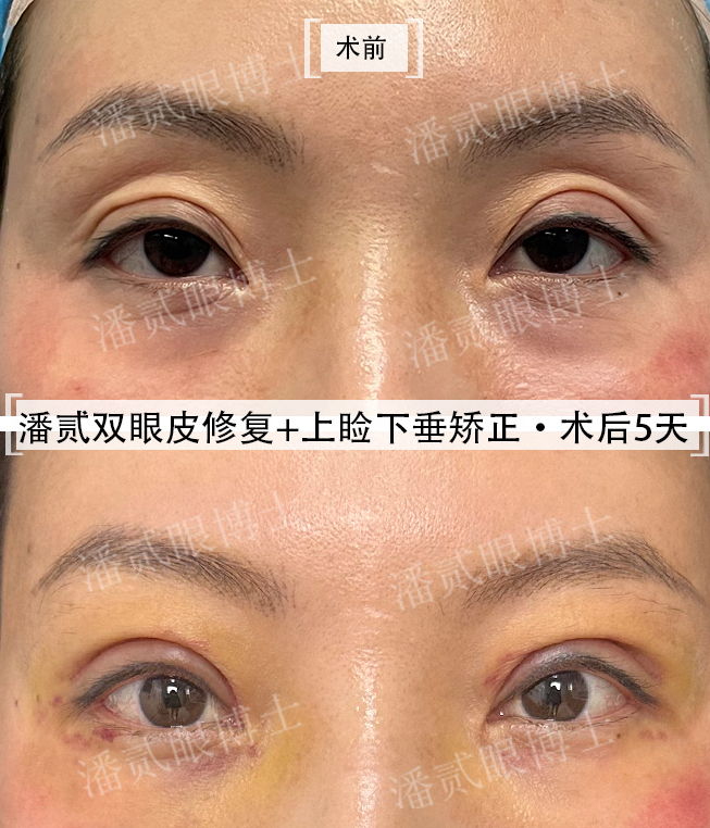 凸眼睛·潘贰双眼皮修复 上睑下垂矫正·术后5天