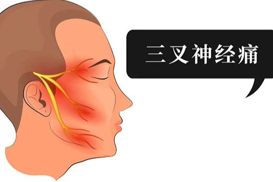 天下第一痛,疼起来真的要命,三叉神经痛