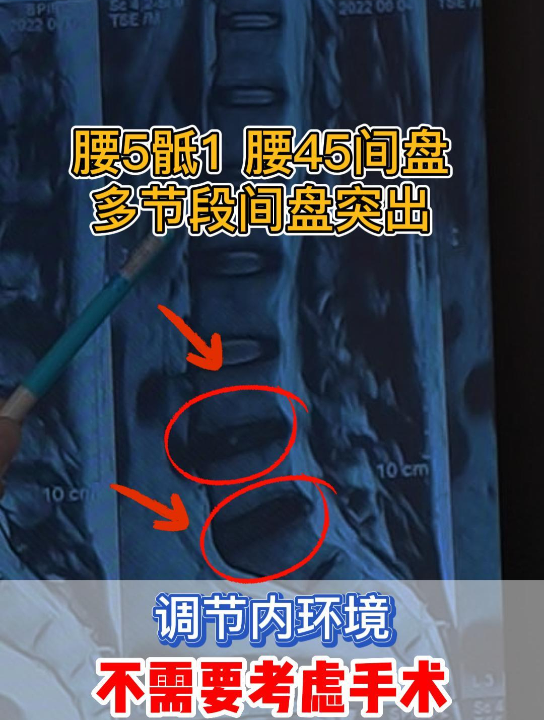 腰5骶1,腰45间间盘突出,可以保守治疗!