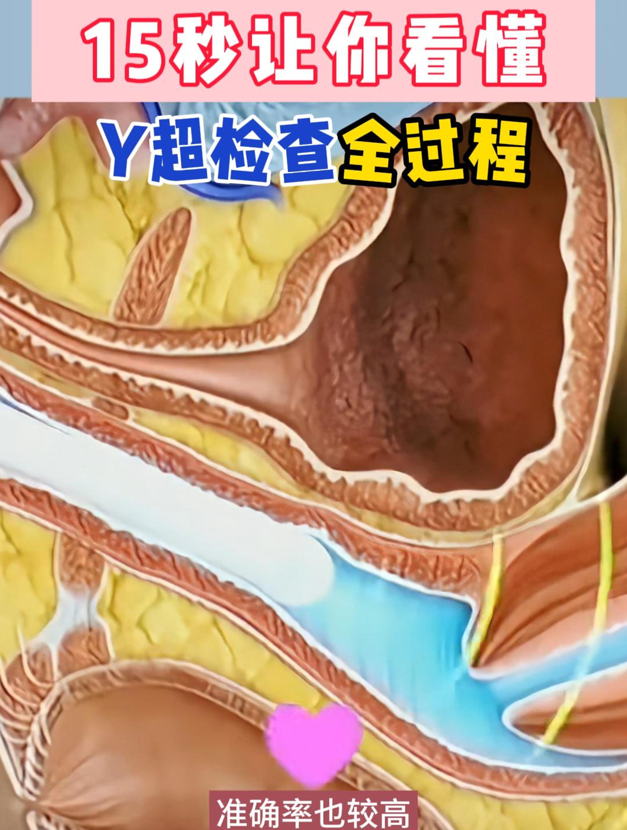 15秒让你看懂阴超检查全过程