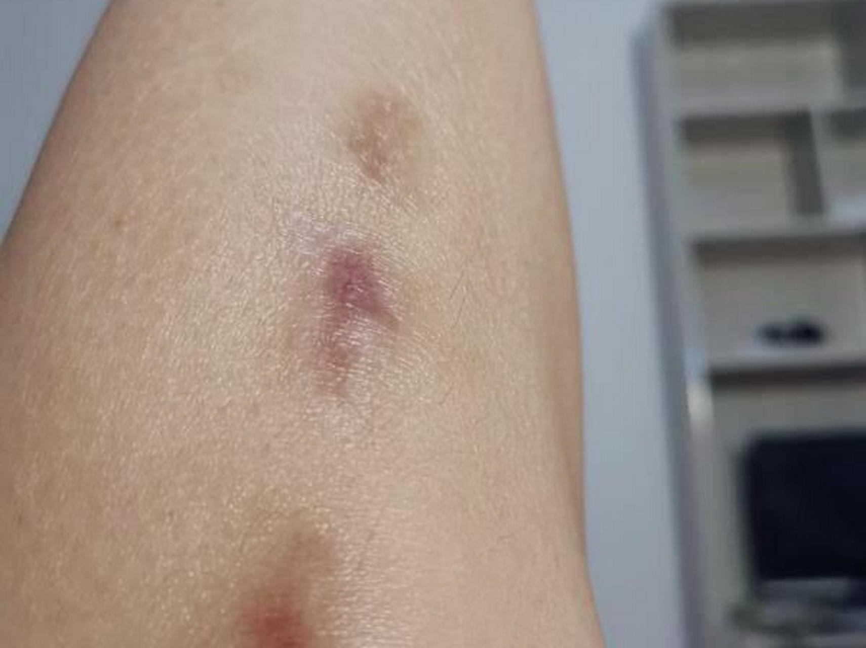 这种黑色印子是炎症后的色素沉着,还不知道怎么去除疤痕色沉的赶紧