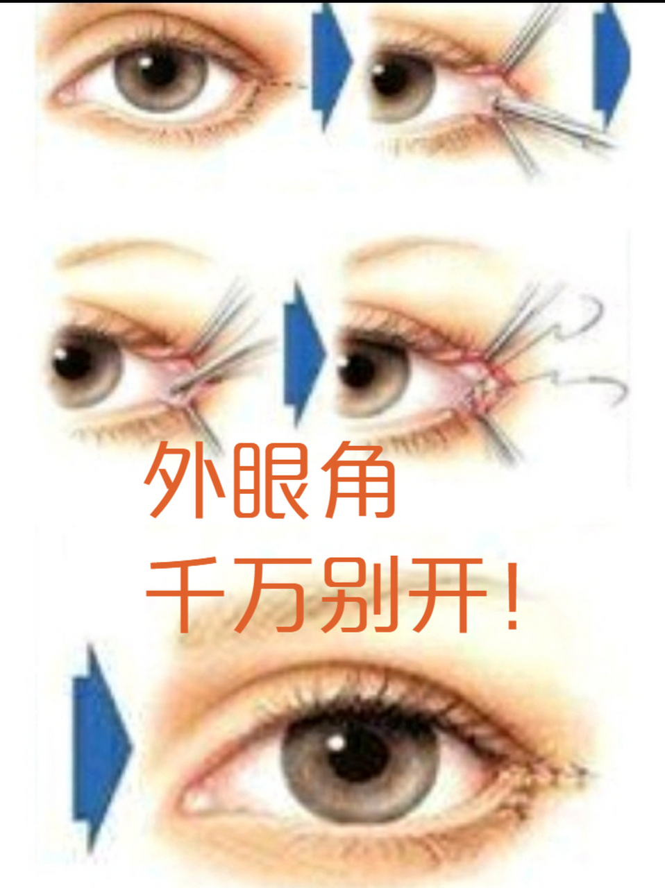 为什么我不建议开外眼角?