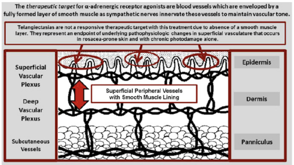 关于玫瑰痤疮的"固定性红斑"和潮红,各自支配的血管类型不同