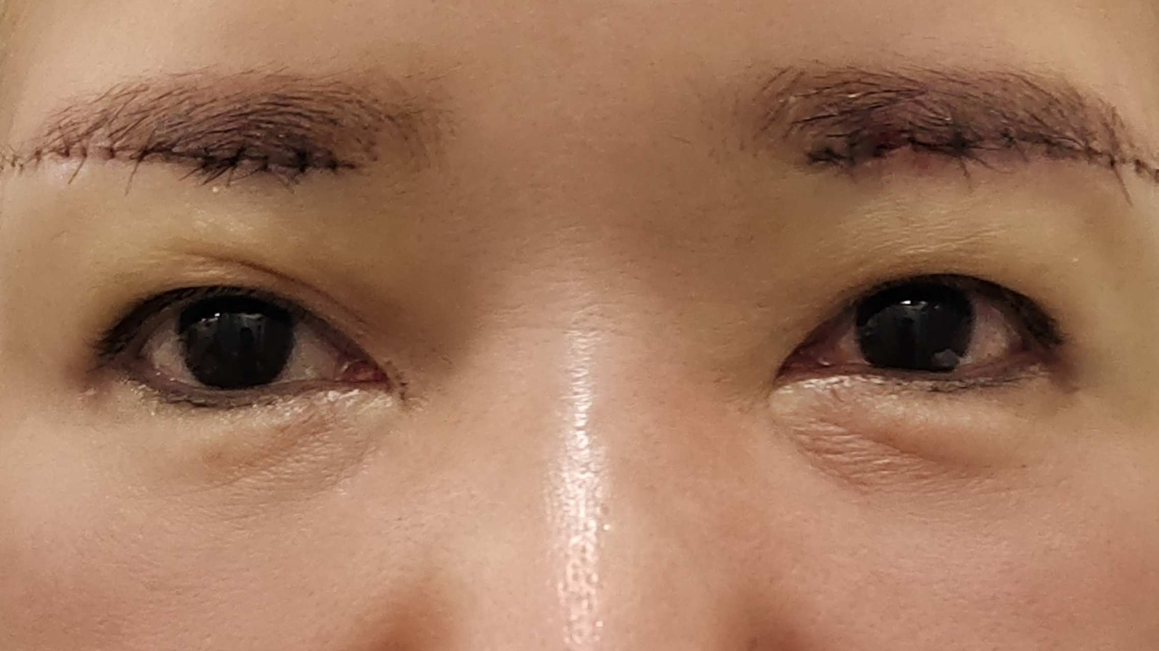 提眉术后即刻案例分享.