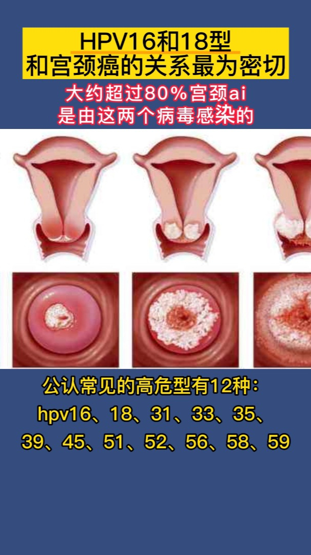 女性hpv16阳性症状图片图片