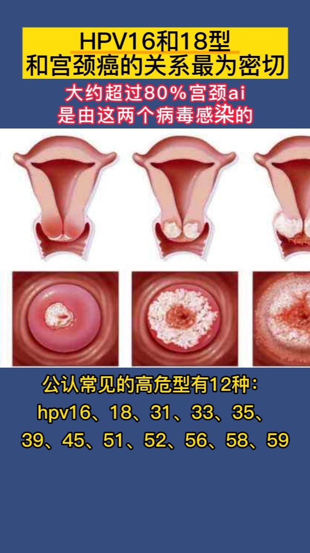 hpv1618阳性和宫颈癌关系最为密切