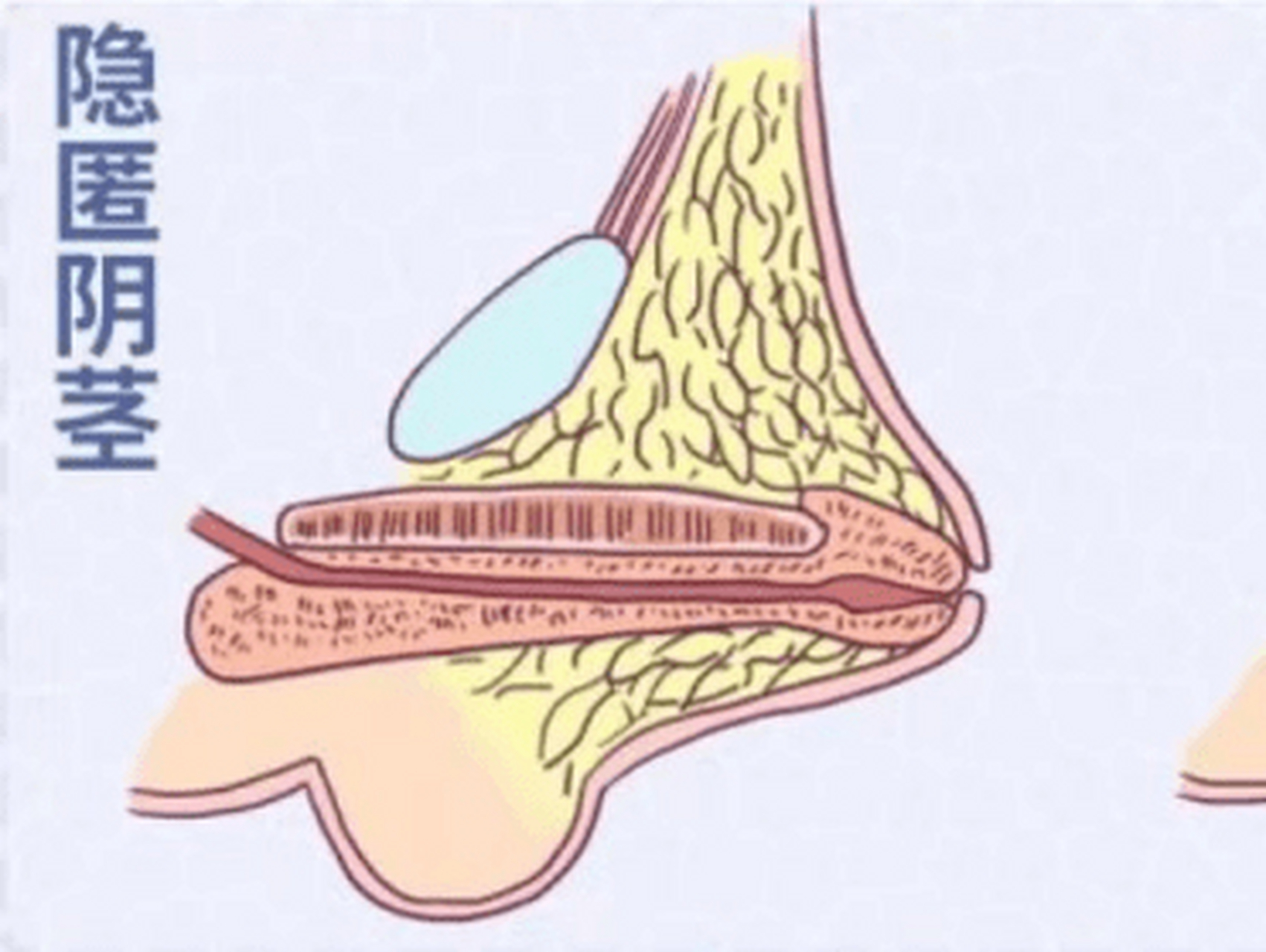 听说有些粉丝非常关注隐匿性阴茎的问题 那么隐匿性阴茎到底是什么呢?