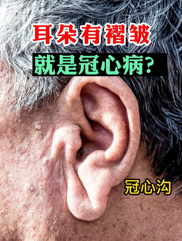 耳朵有褶皱可能是冠心病?