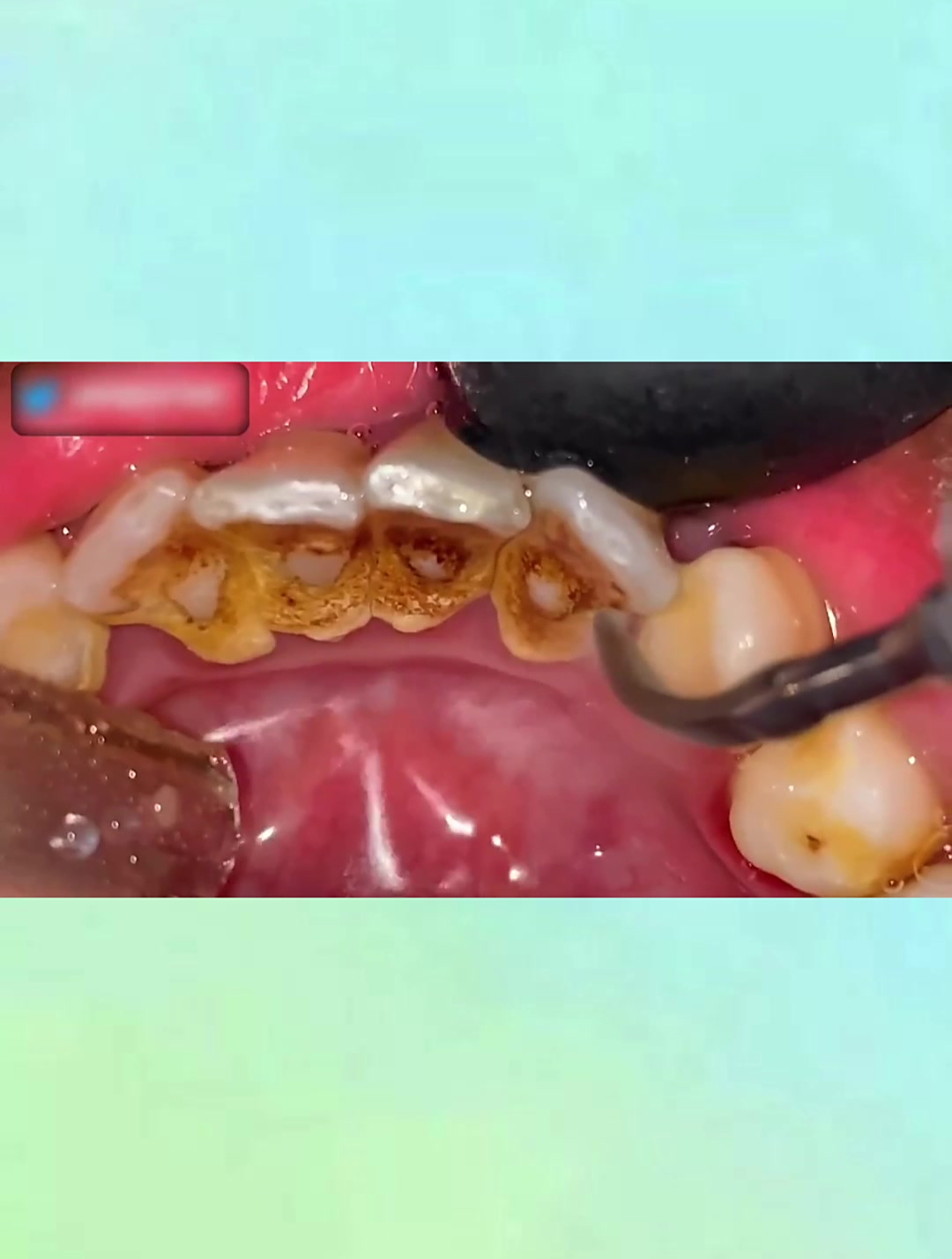 8年不刷牙换来满口牙结石,牙医都惊呆,清理过程极解压!