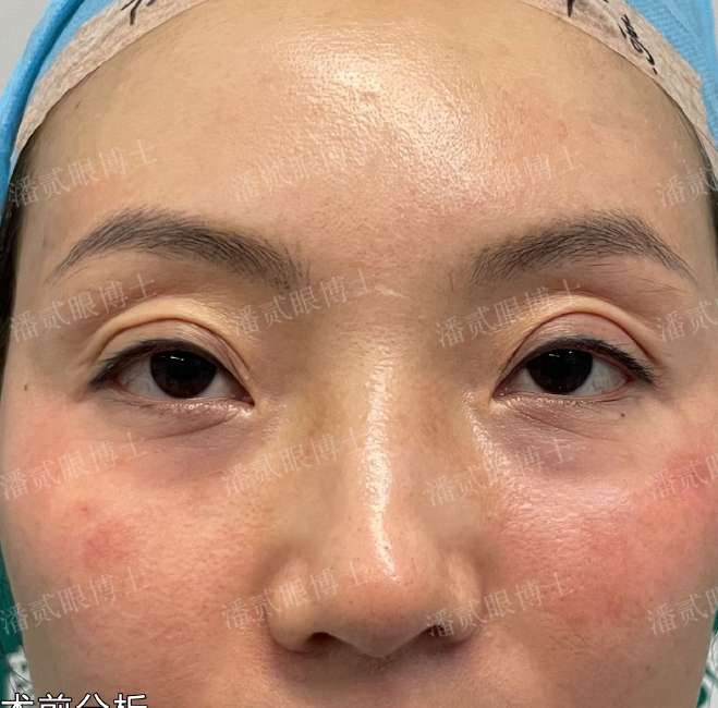 凸眼睛·潘贰双眼皮修复 上睑下垂矫正·术后5天