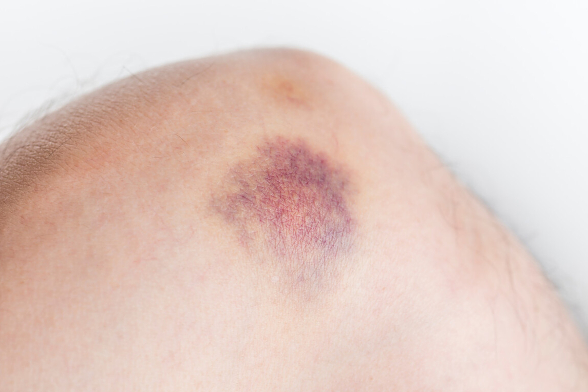 血府逐瘀汤,行气而活血,能化掉体内瘀血,治疗各种怪病的妙方