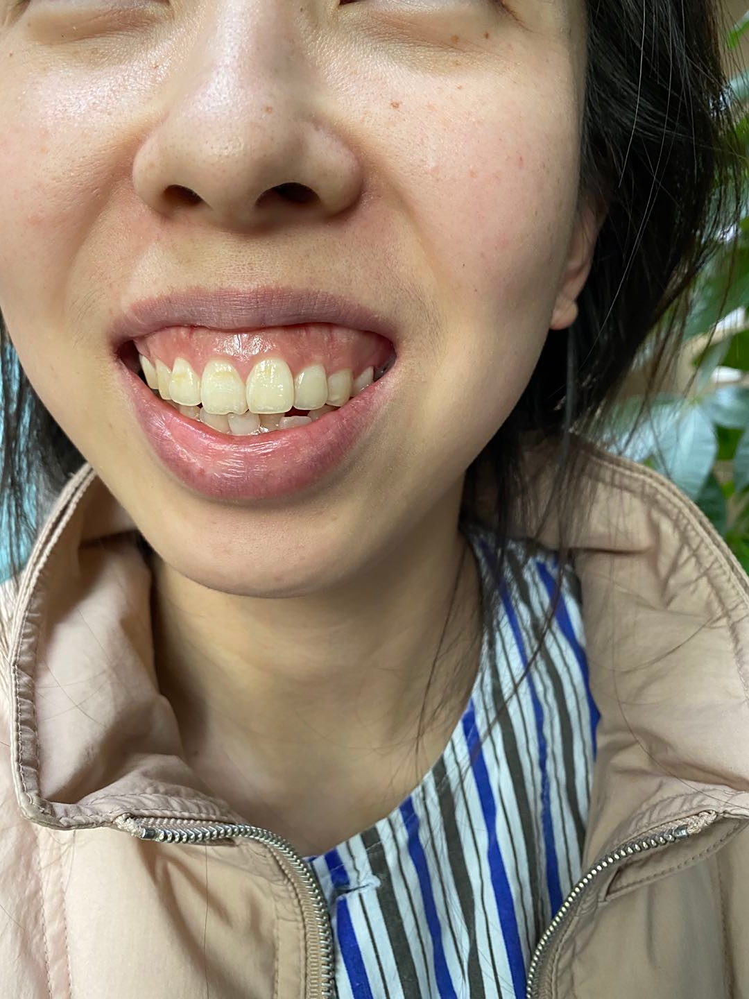 凸嘴露龈笑如何改善?