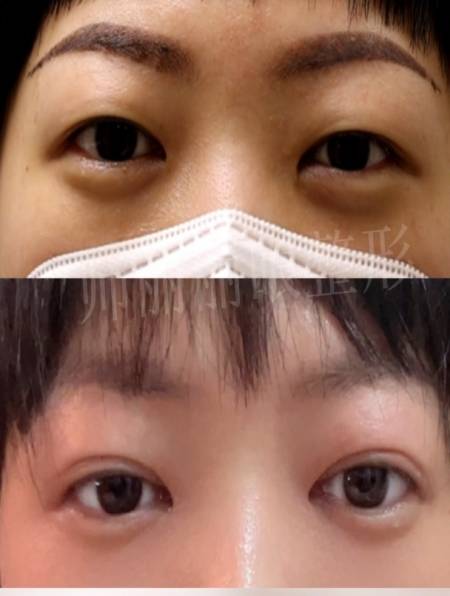 肿眼泡全切 术后21天效果~ 双眼皮