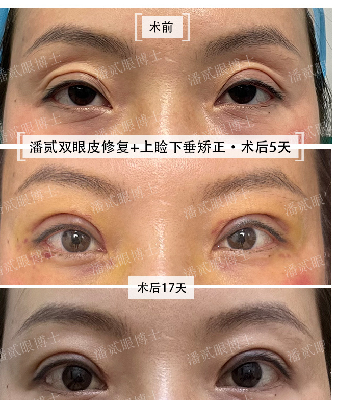 凸眼睛·潘贰双眼皮修复 上睑下垂矫正·术后17天