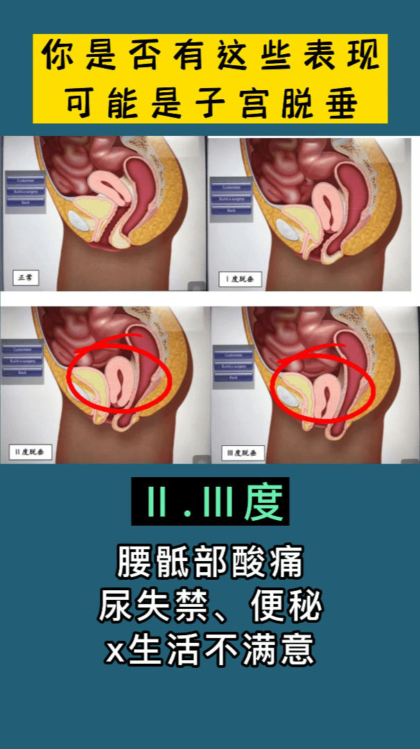 你是否有这些表现,可能是子宫脱垂-度小视