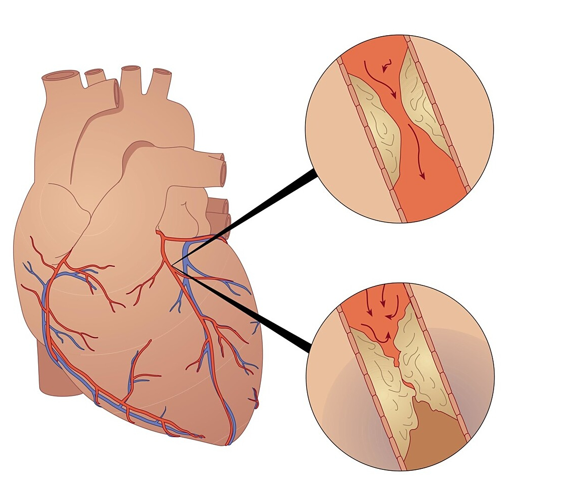 关于心肌缺血心绞痛,这4个知识点要知道,关键时刻能保命