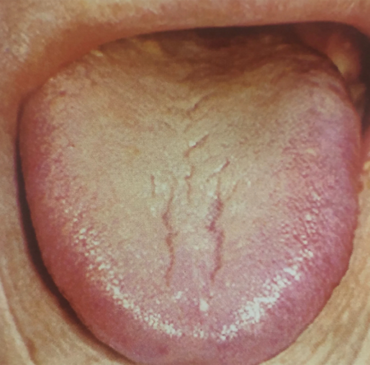 今天给大家分享一个患者舌相  大家可以看到这个舌相,舌头颜色比较浅