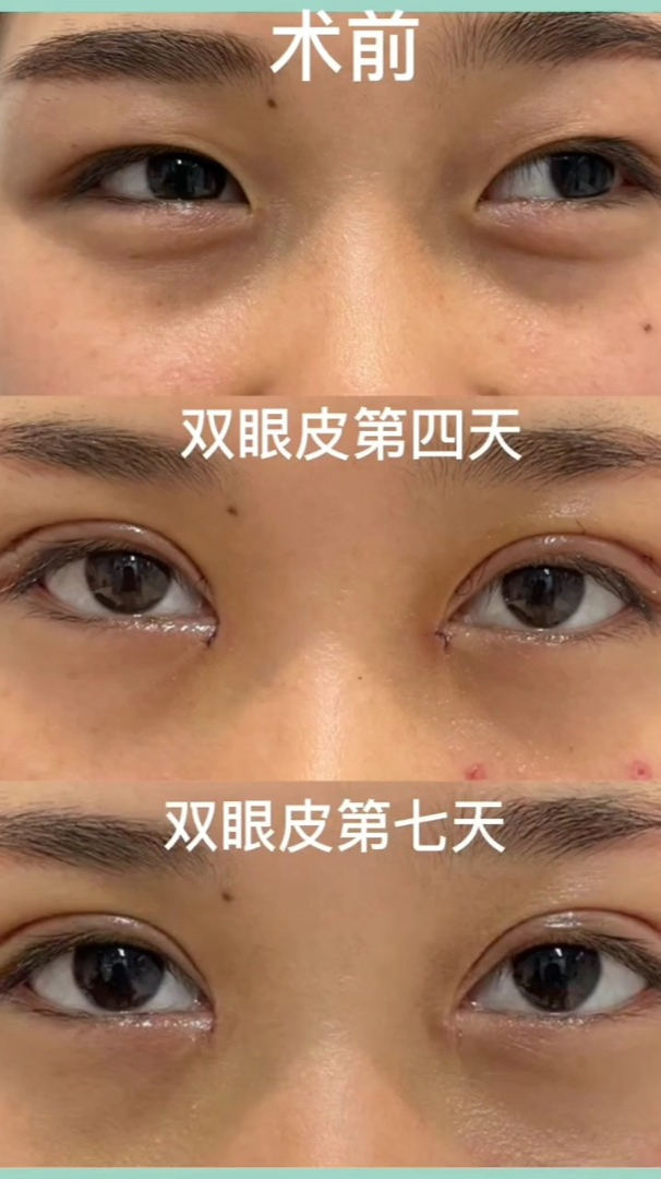 双眼皮7天拆线一个月后恢复自然2个月后太好看了吧