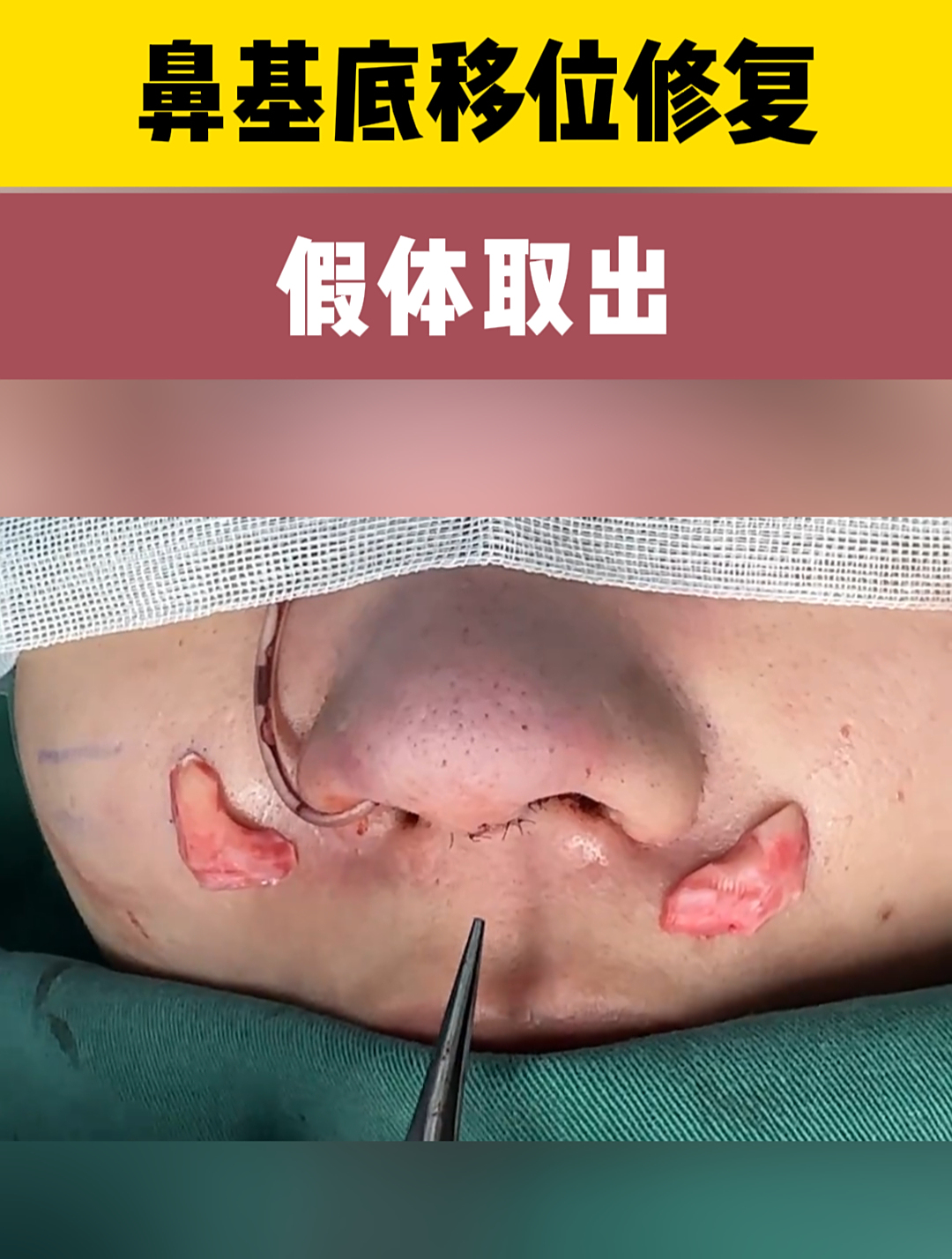 膨体填充2年后会怎么样?32岁女士鼻基底移位修复,假体取出