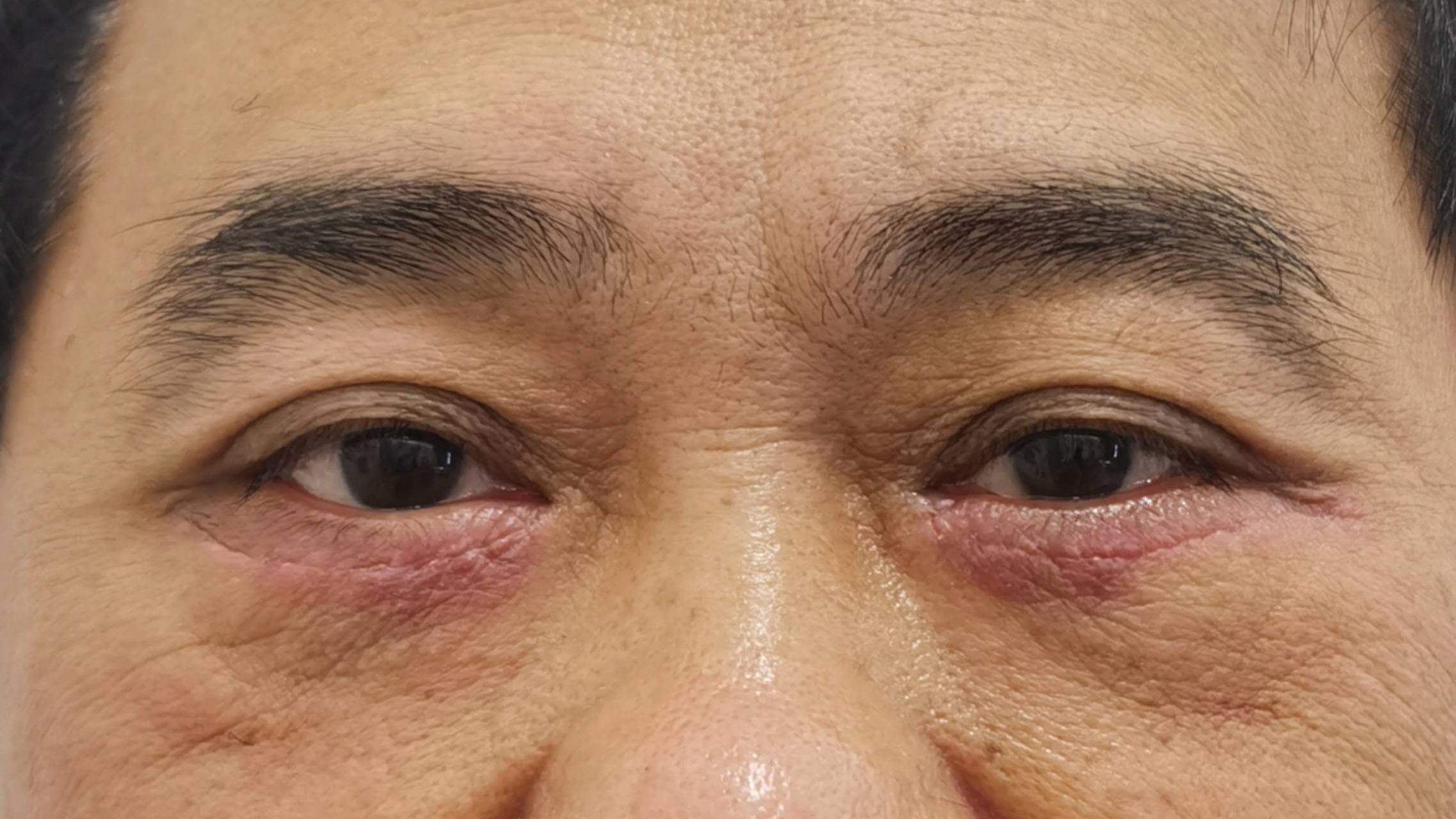 【外切眼袋】案例分享 眼袋影响的不光是一个人的状态,气质,也反映着