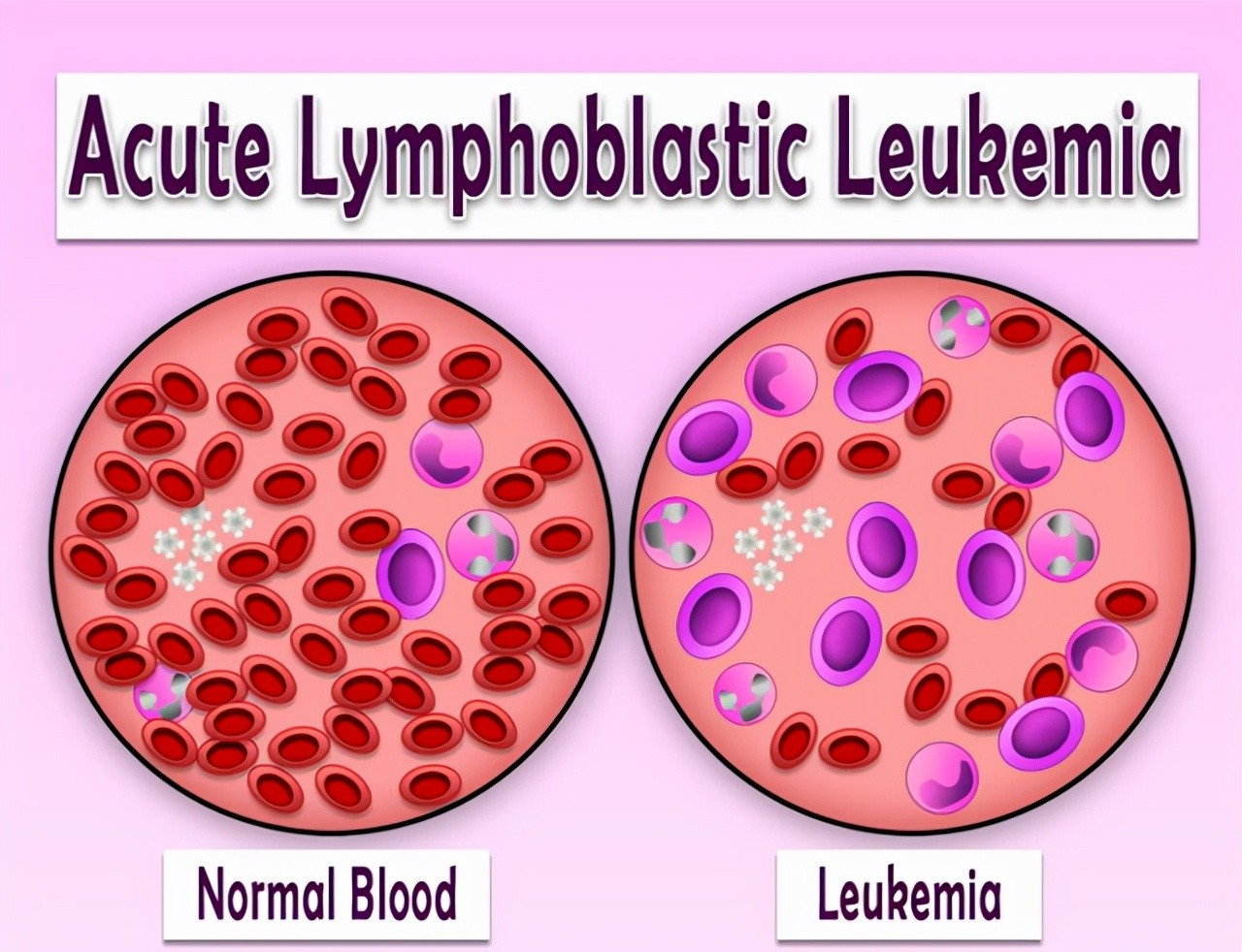 越来越多的孩子患白血病,与2种物质脱不了关系,早知道早预防