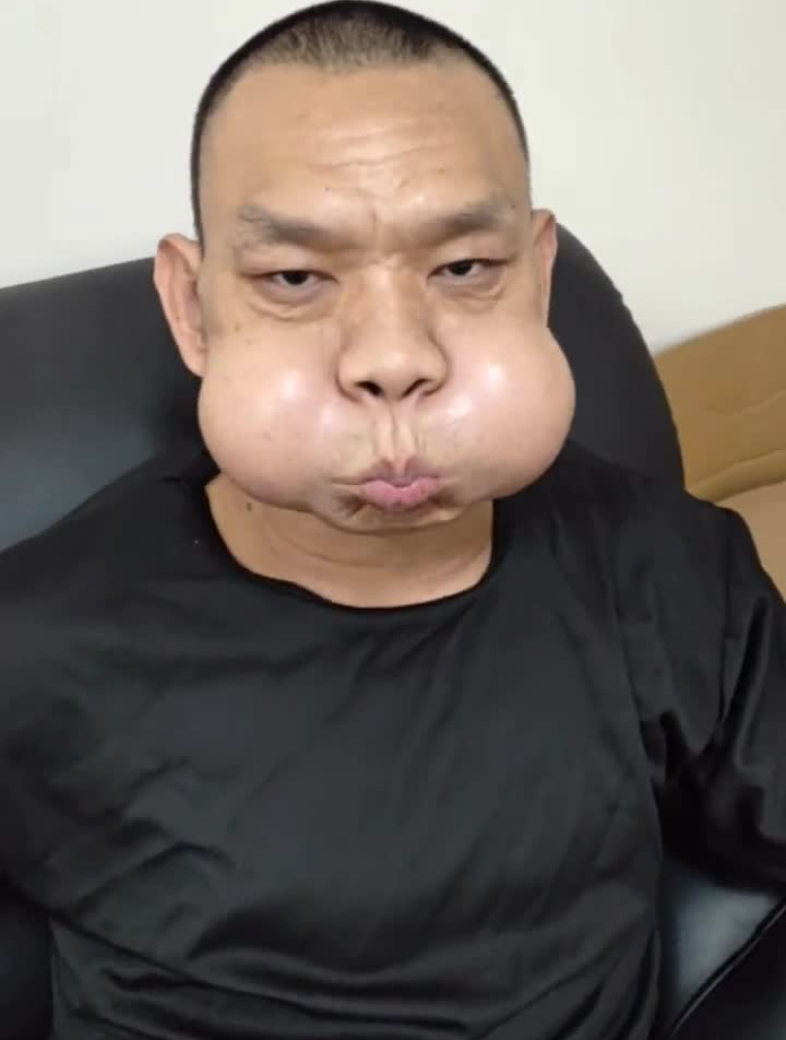 昆仑派的高手蛤蟆功第99层世界上最大号的腮帮子!