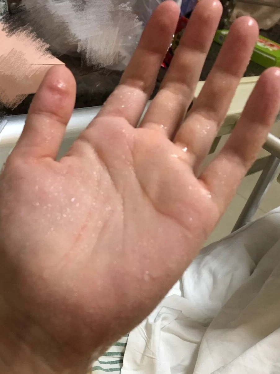 怎么样治手心脚心出汗