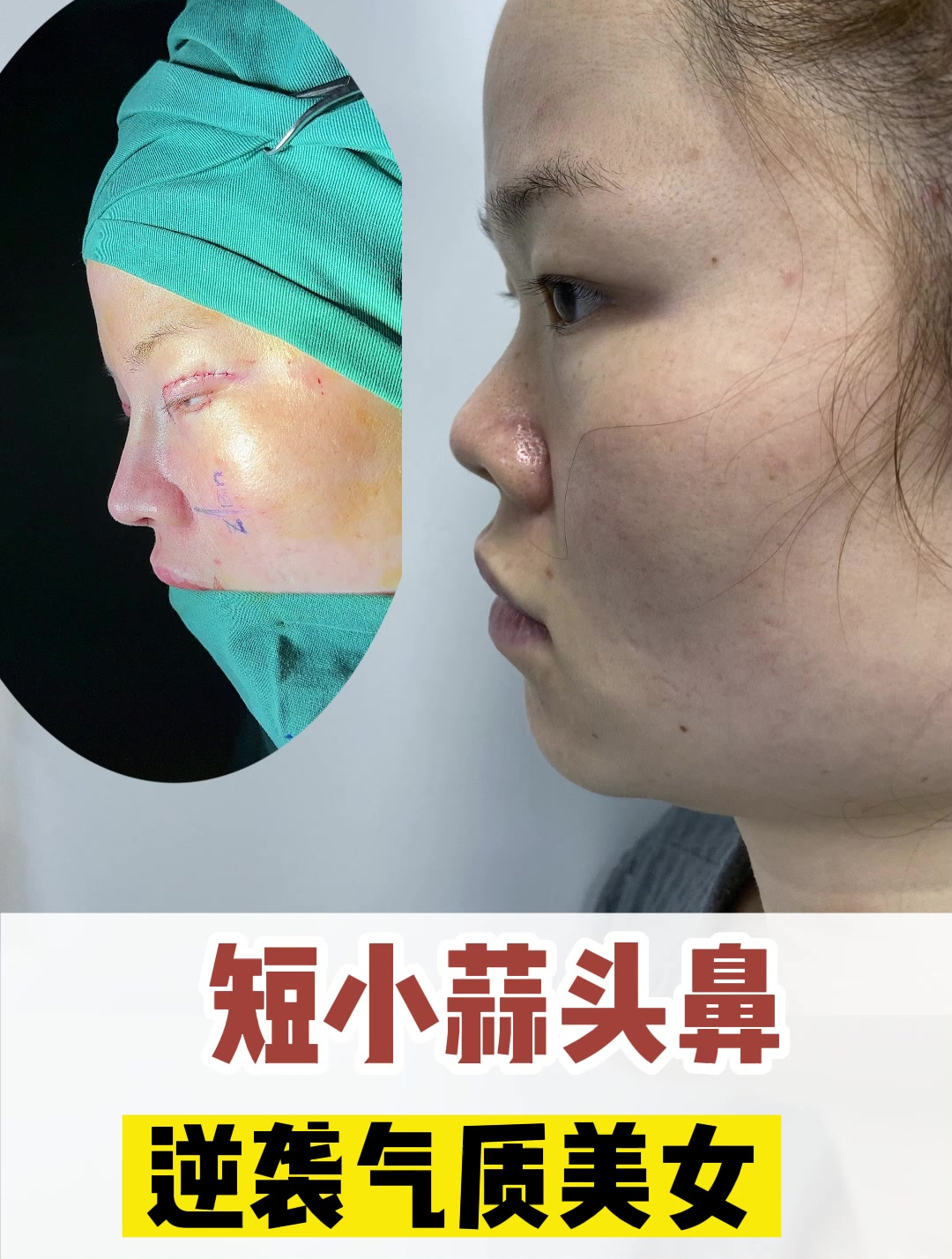 25岁姑娘短小蒜头鼻,逆袭气质美女-度小视