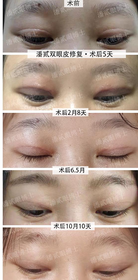 多层双眼皮修复·潘贰双眼皮修复·术后10月10天