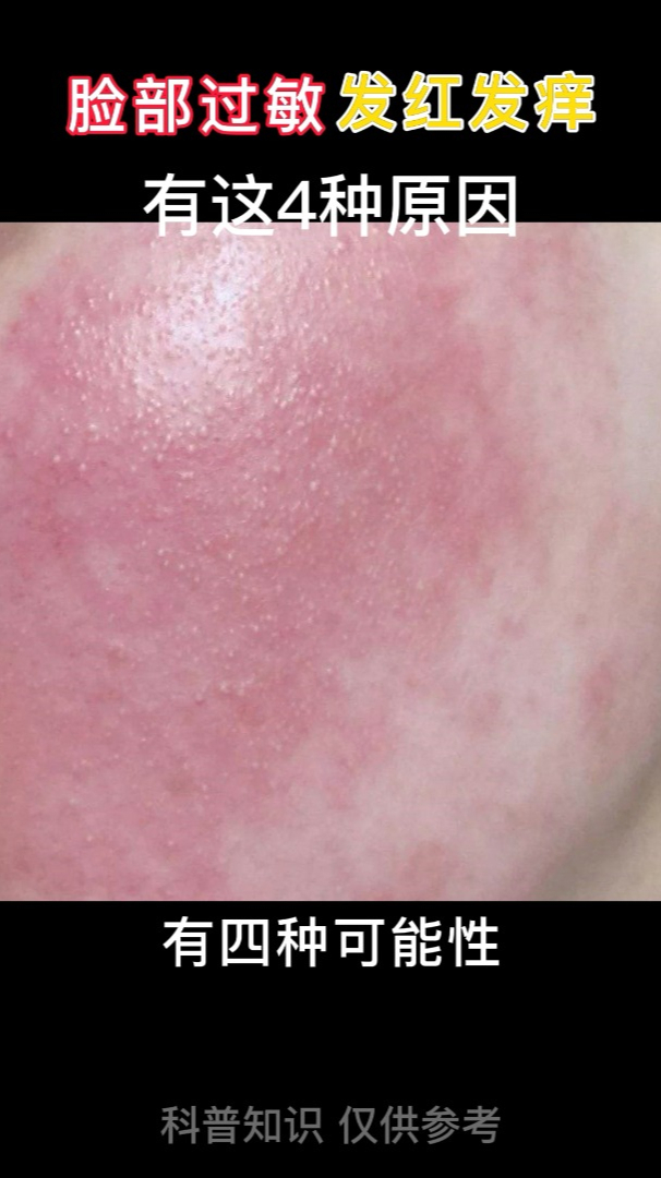 脸部过敏发红发痒有这4种原因