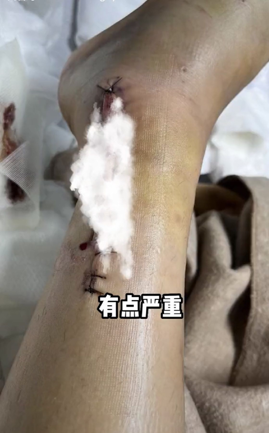 陈学冬车祸后报平安:腿部受伤严重打钢钉,不过还好脸没事!