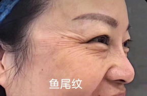 鱼尾纹,鸡爪纹不知道怎么处理?看完你就明白了