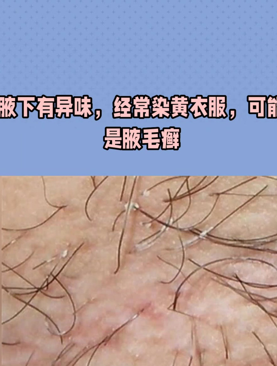 上海江城|腋下有异味,经常染黄衣服,可能是腋毛癣