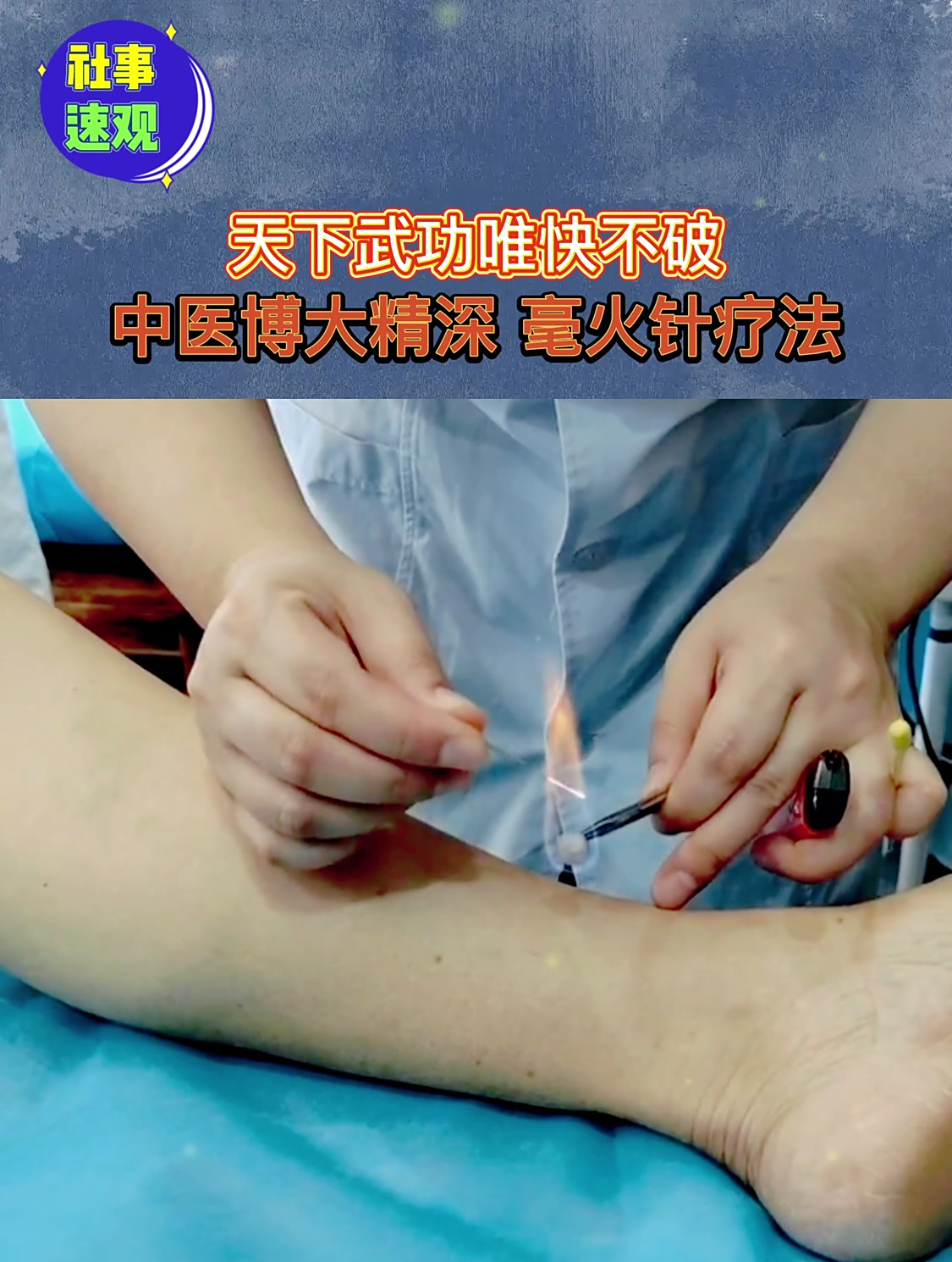中医博大精深,毫火针疗法!确定扎进去不会烫熟吗?