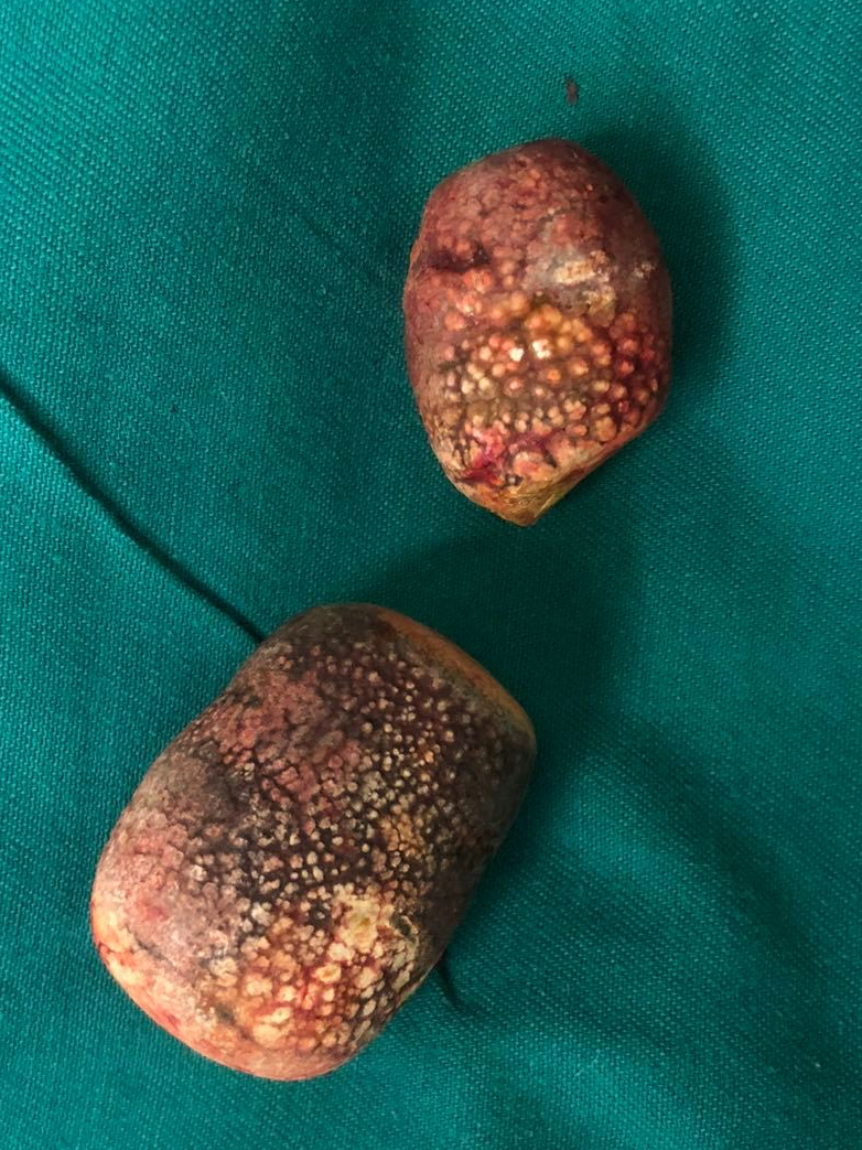 慢性胆囊炎患者的饮食注意事项