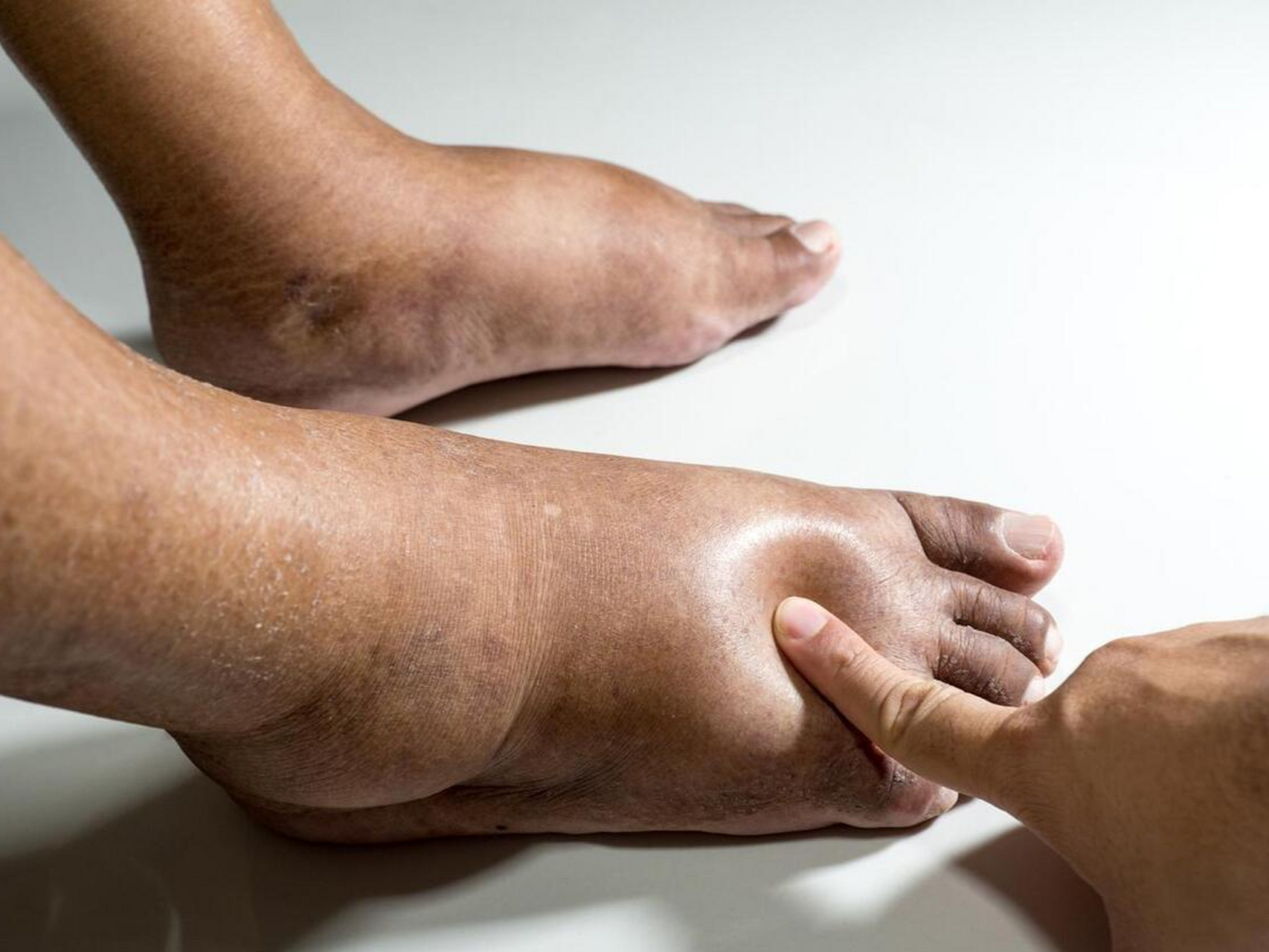 双脚有这5个表现,请立即就医,千万别拖成糖尿病足!