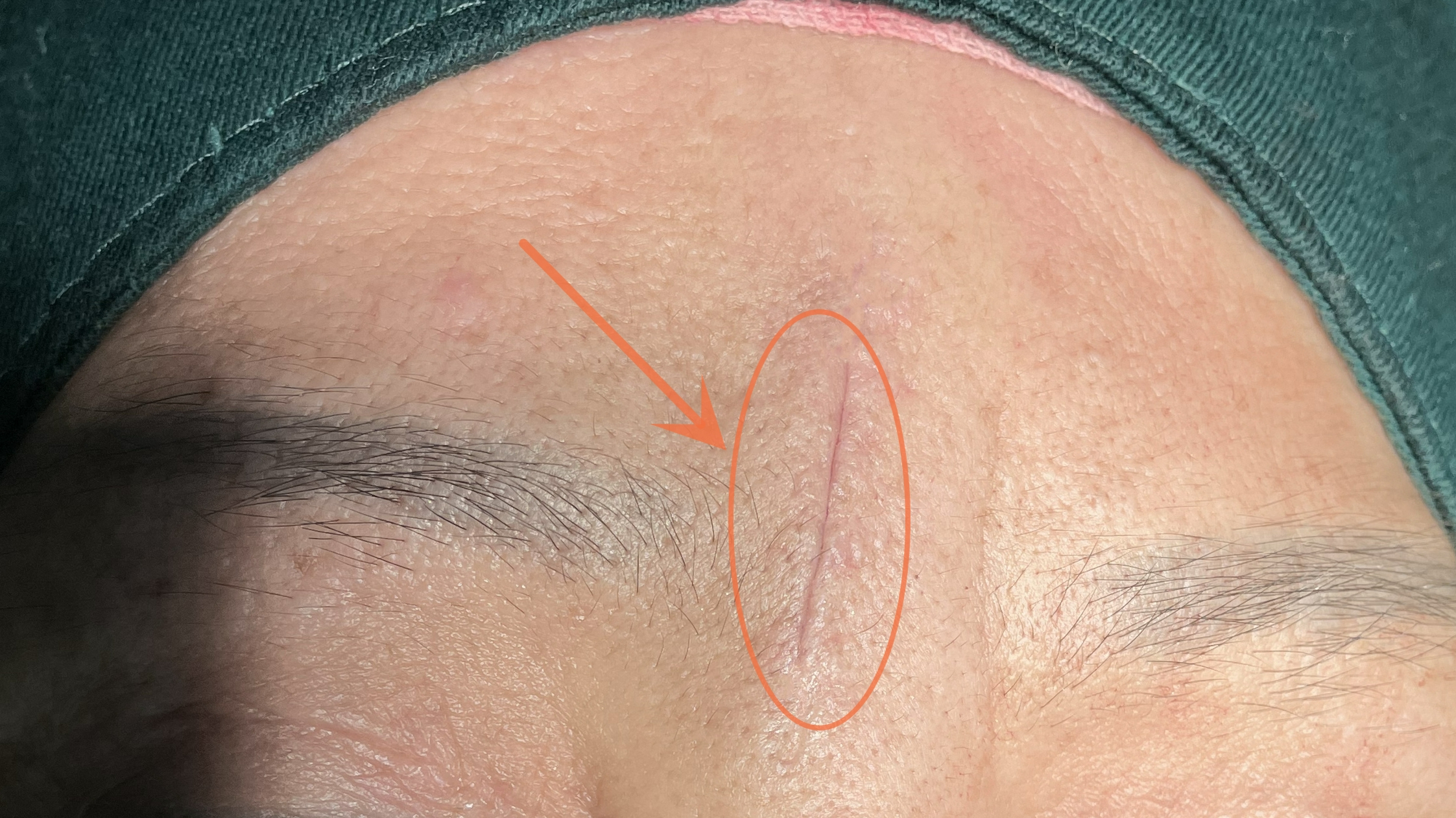 眉间川字纹越来越厉害凹陷明显,医生说可以切除?效果怎么样?